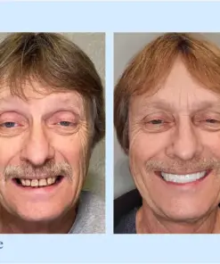 HZA™ - Premium Denture🦷