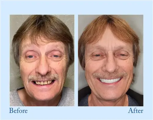 HZA™ - Premium Denture🦷